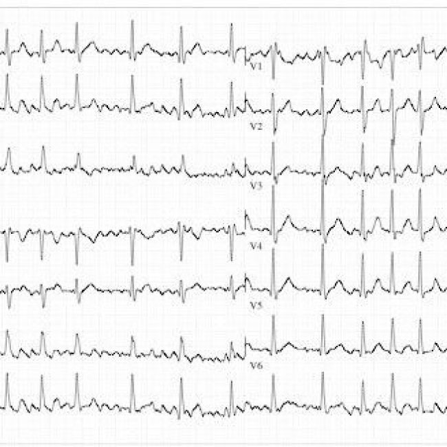 Alternativas al Sintrom en la fibrilación auricular