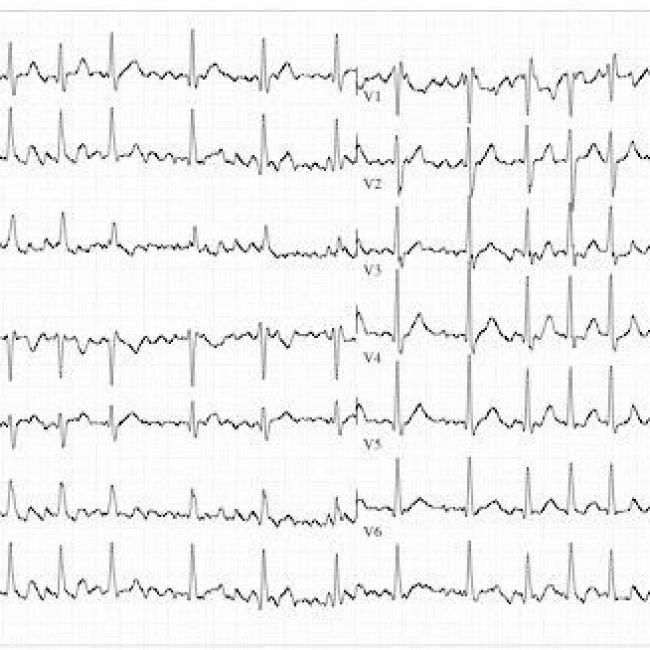 Alternativas al Sintrom en la fibrilación auricular