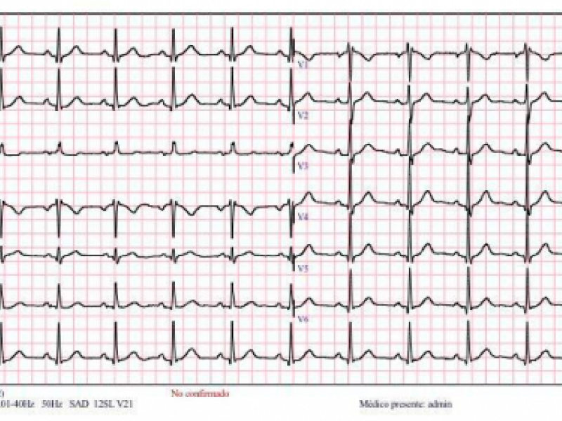 Electrocardiograma