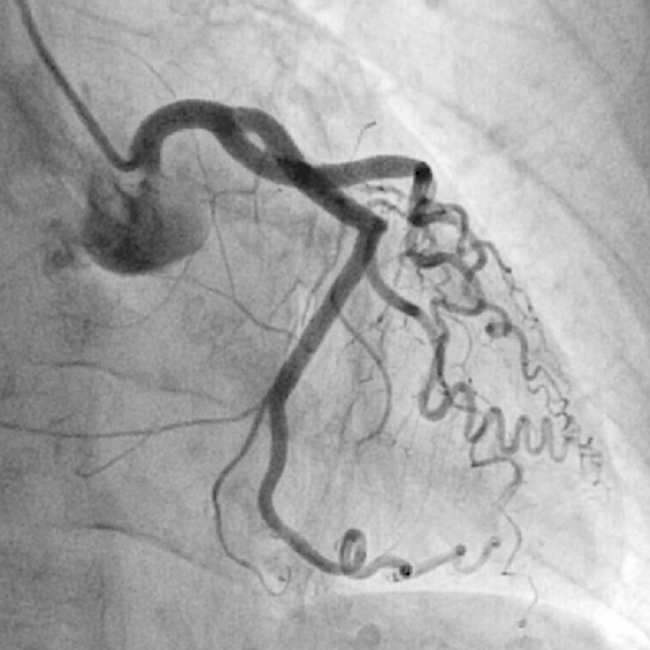 Tratamiento del infarto de miocardio