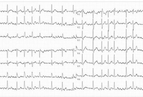 Alternativas al Sintrom en la fibrilación auricular
