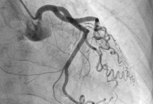 Tratamiento del infarto de miocardio