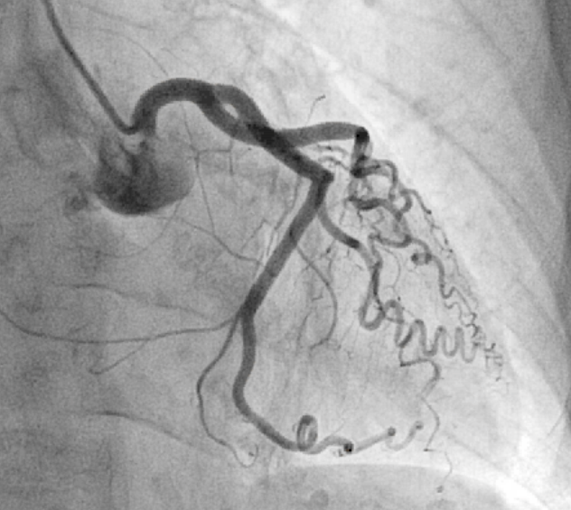 Tratamiento del infarto de miocardio