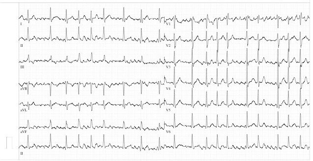 Alternativas al Sintrom(R) en la fibrilación auricular