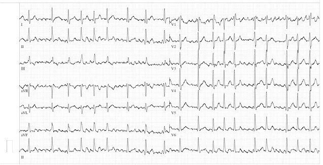 Holter ECG